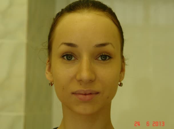 Эндоскопический лифтинг лба - после