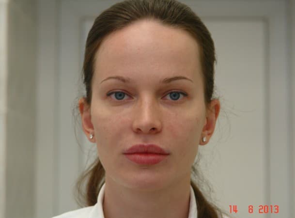 Эндоскопический лифтинг лба - после