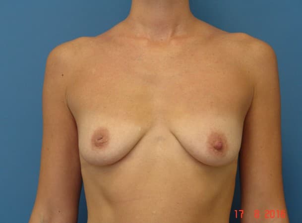 Периареолярное увеличение груди - до