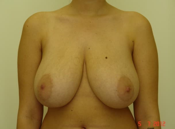 Уменьшение груди - до