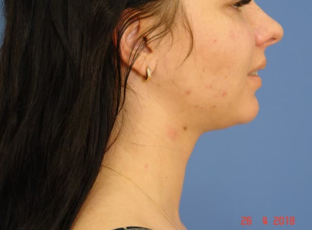Липосакция подбородка - после