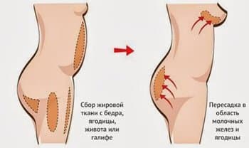 процедура липофилинга