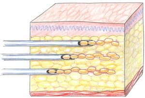забор жировой ткани при липофилинге