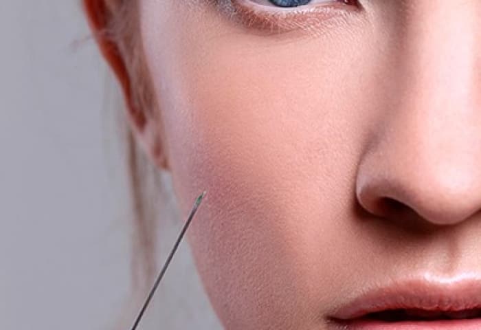 Контурная пластика носогубных складок