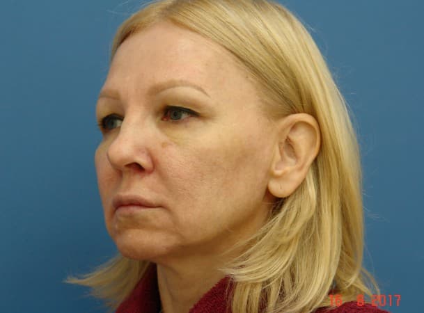 СМАС-лифтинг лица, блефаропластика верхних век - до