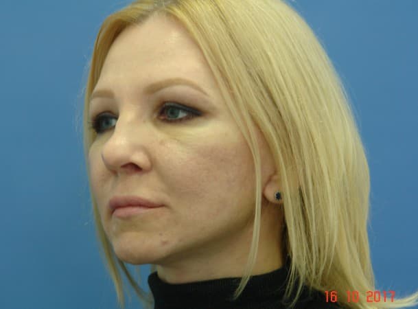 СМАС-лифтинг лица, блефаропластика верхних век - После (Анфас)