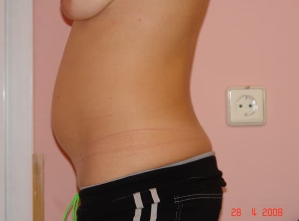 Липосакция живота - до