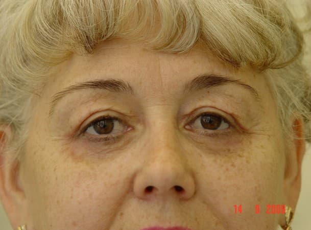 Блефаропластика верхних и нижних век - после