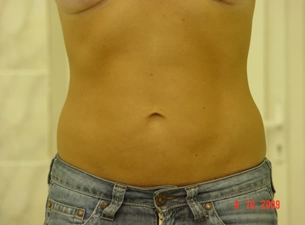 Липосакция живота - после