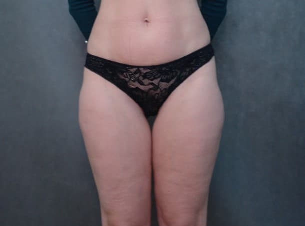 Липосакция колен, наружных бедер, липофилинг ягодиц - До (Анфас)