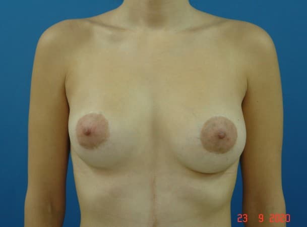Липофилинг груди, коррекция - До (Анфас)
