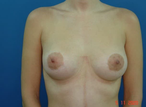 Липофилинг груди, коррекция - После (Анфас)