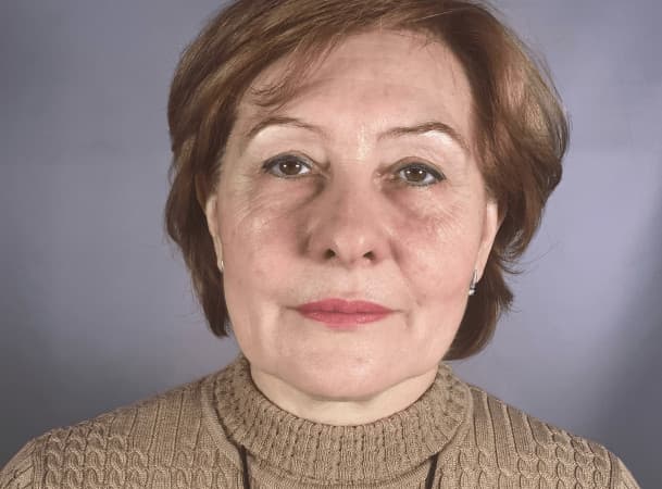 Эндоскопический лифтинг лба, Блефаропластика верхних век, Блефаропластика нижних век, Эндоскопическая подтяжка средней зоны, СМАС-лифтинг, Липосакция подбородка и брылей - До (Анфас)