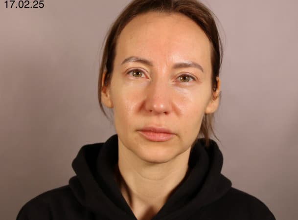 Блефаропластика верхних век - До (Анфас)