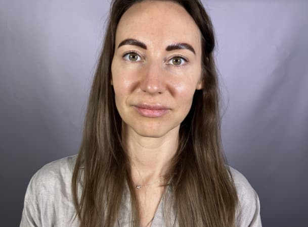 Блефаропластика верхних век - После (Анфас)