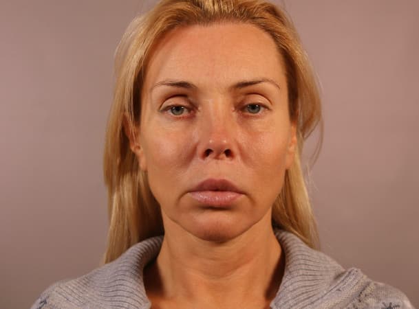 Блефаропластика нижних век, СМАС-лифтинг лица, Платизмопластика шеи - до