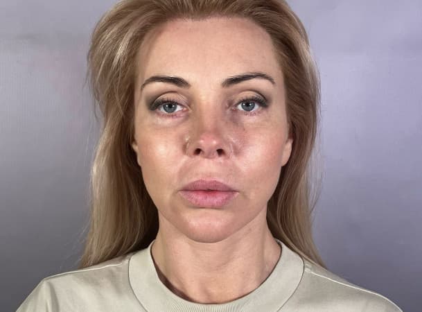 Блефаропластика нижних век, СМАС-лифтинг лица, Платизмопластика шеи - после