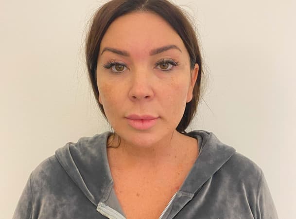 СМАС-лифтинг, Платизмопластика - До (frontView)