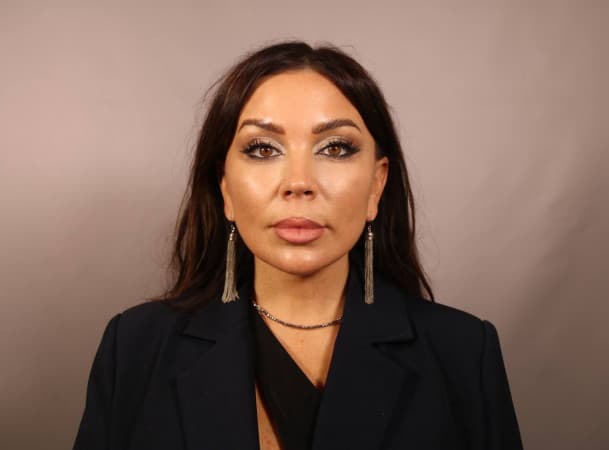 СМАС-лифтинг, Платизмопластика - После (frontView)