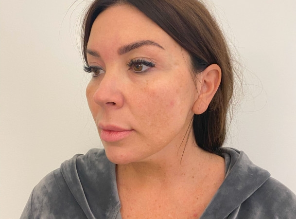 СМАС-лифтинг,  Платизмопластика - До (threeQuarterView)