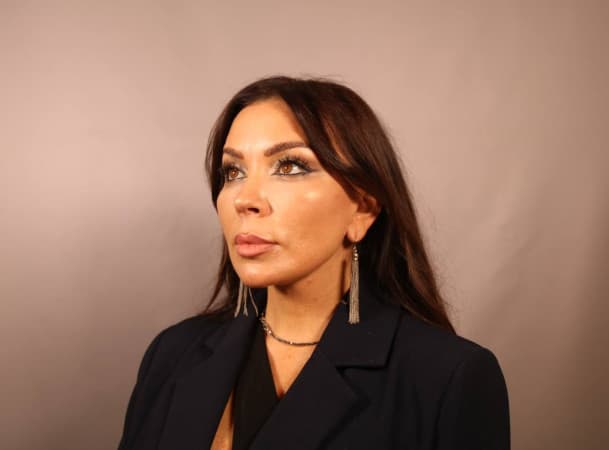 СМАС-лифтинг, Платизмопластика - После (threeQuarterView)