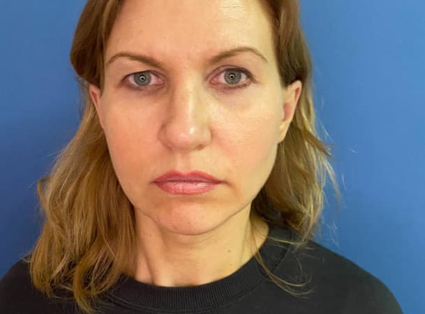 Эндоскопический лифтинг лба, Расширенная блефаропластика - До (Анфас)