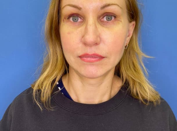 Эндоскопический лифтинг лба, Расширенная блефаропластика - После (Анфас)