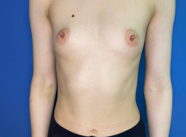 Увеличение груди - до