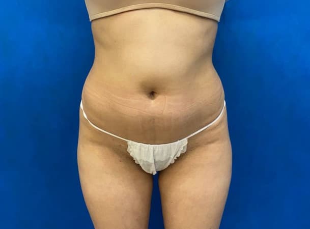 Липосакция живота и талии - до