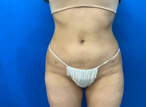 Липосакция живота и талии - после