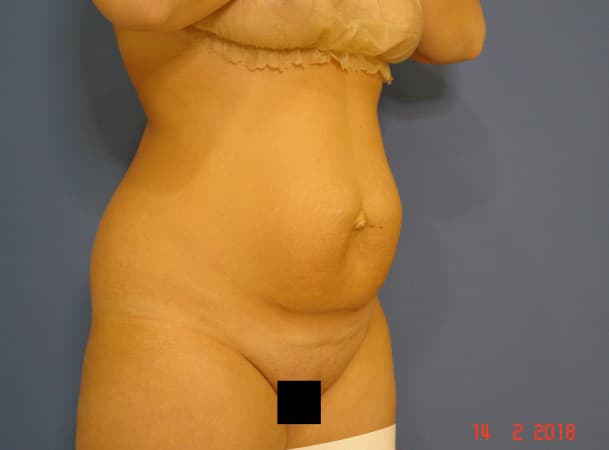 Абдоминопластика - До (Три четверти)