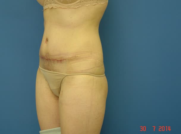 Абдоминопластика - После (Три четверти)