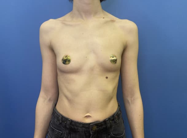 Эндоскопическое увеличение груди - До (Анфас)