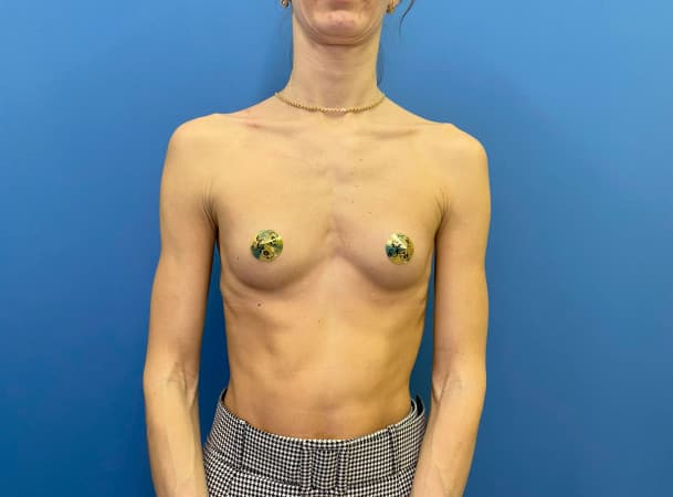 Эндоскопическое увеличение груди - До (Анфас)