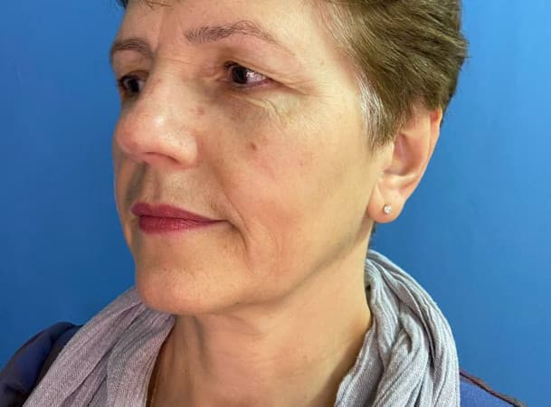 Эндоскопический лифтинг лба, Блефаропластика верхних век - До (frontView)