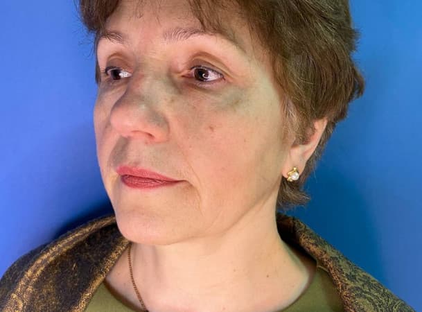 Эндоскопический лифтинг лба, Блефаропластика верхних век - После (frontView)