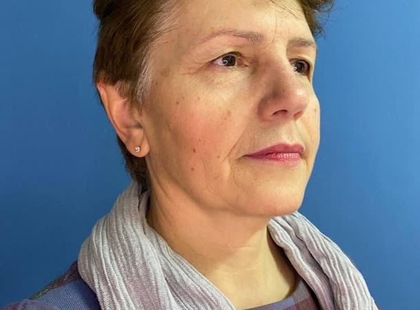 Эндоскопический лифтинг лба, Блефаропластика верхних век - До (threeQuarterView)