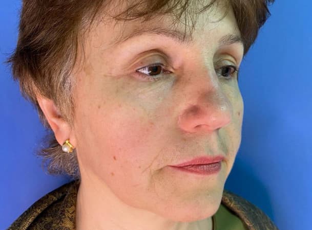 Эндоскопический лифтинг лба, Блефаропластика верхних век - После (threeQuarterView)