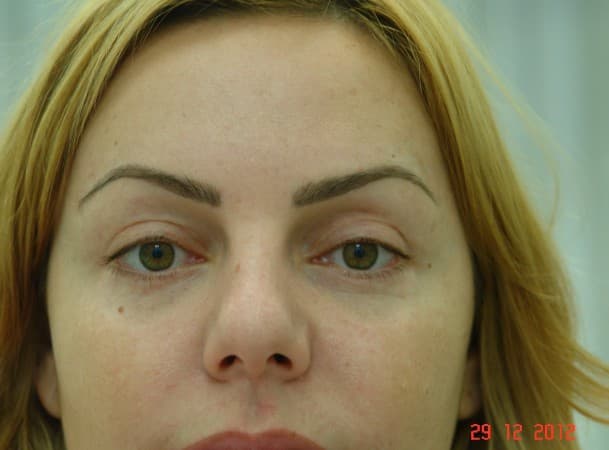 Блефаропластика верхних и нижних век - после