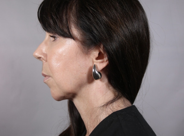 Лифтинг лба и овала лица - До (sideView)