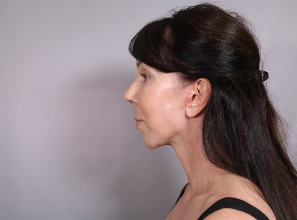 Лифтинг лба и овала лица - После (sideView)