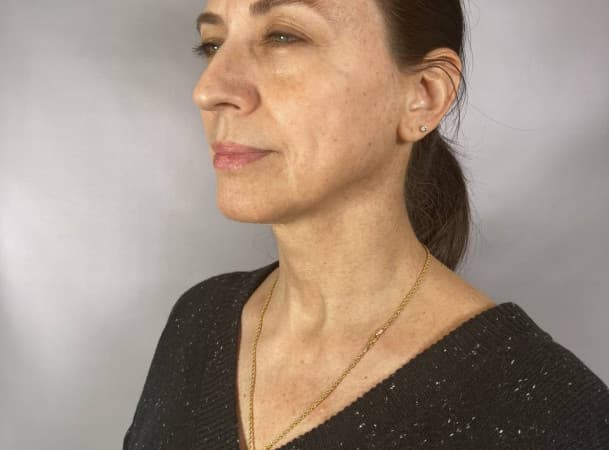 Пластика лица - До (threeQuarterView)