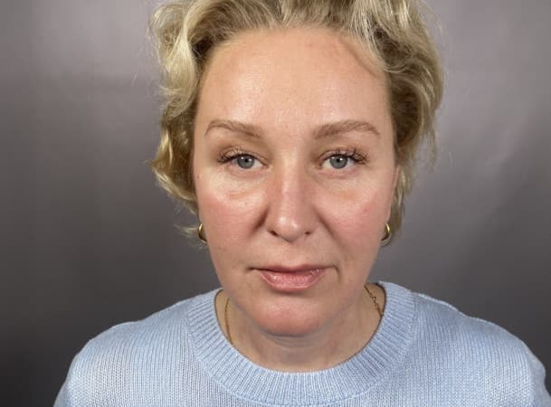 Подтяжка лба, блефаропластик нижних век - После (frontView)