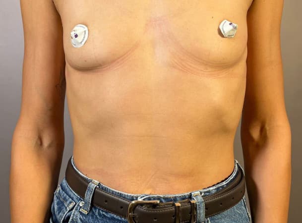 Эндоскопическое увеличение груди - до