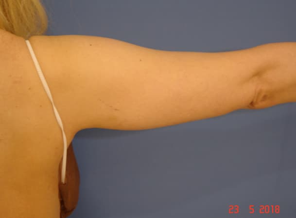 Липосакция рук - До (Анфас)