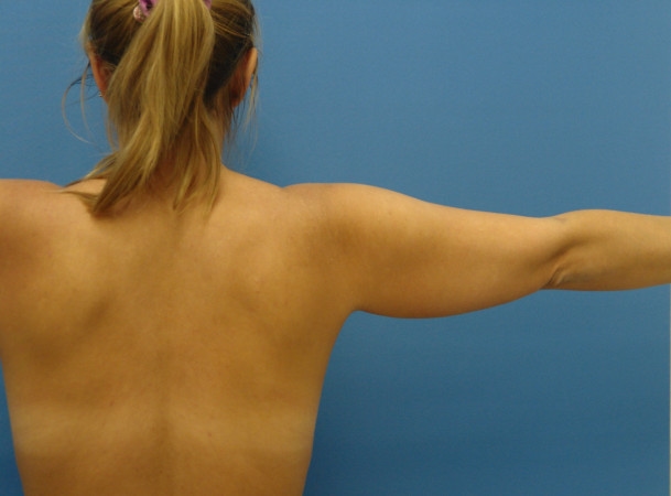 Липосакция рук - до