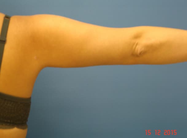 Липосакция рук - После (Анфас)