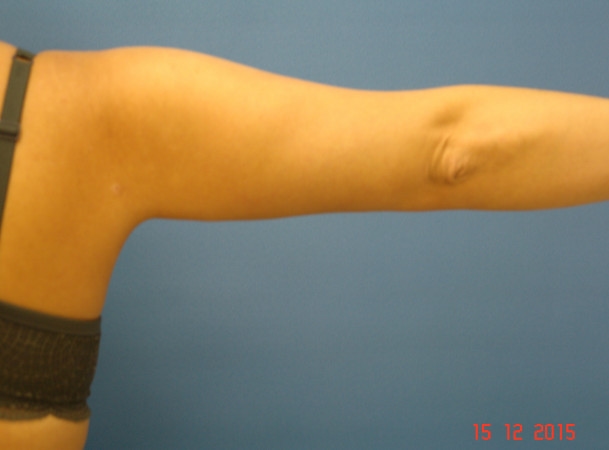 Липосакция рук - после