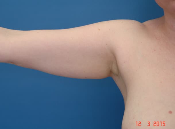 Липосакция рук - До (Анфас)