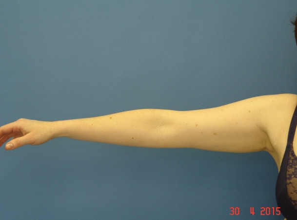 Липосакция рук - после